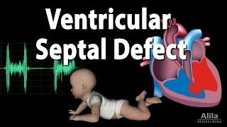 Ventricular Septal Defect Animation [upl. by Ilona832]