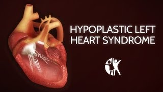 Hypoplastic Left Heart Syndrome  Echo HLHS [upl. by Narik]