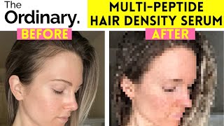 THE ORDINARY MULTIPEPTIDE SERUM FOR HAIR DENSITY REVIEW  BEFORE AND AFTER  6 MONTH UPDATE [upl. by Snilloc509]