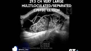 Mucinous Cystadenoma Ultrasound [upl. by Asseral]