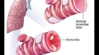 Wheeze Bronchiolitis [upl. by Laiceps82]