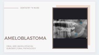 AMELOBLASTOMA [upl. by Etz]