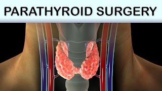 Parathyroid Surgery Medical Animation [upl. by Hoebart508]