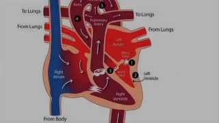 Fetal echocardiography at 1113 weeks Hypoplastic Left Heart Syndrome HLHS [upl. by Nnaihs]