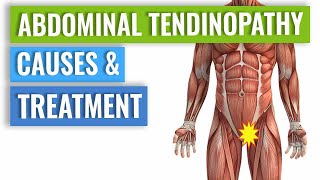 Abdominal Tendinopathy  Causes and Treatment Including Exercises [upl. by Tnemelc]