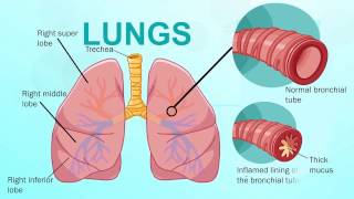 Chronic Bronchitis  Respiratory System [upl. by Laud132]