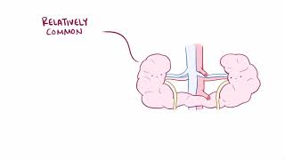 Horseshoe kidney renal fusion causes symptoms diagnosis treatment amp pathology [upl. by Adia]