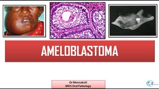 Ameloblastoma  Benign Odontogenic Tumor [upl. by Enytsirhc]