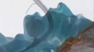 Laryngeal Mask Airway Insertion [upl. by Dew733]