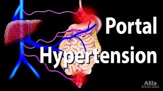 Portal Hypertension Animation [upl. by Randall]