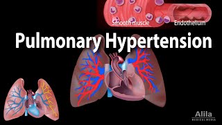 Pulmonary Hypertension Animation [upl. by Feinberg]