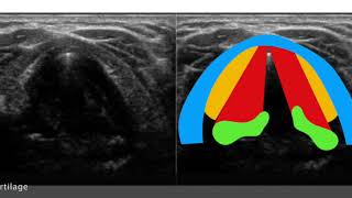 Neck Larynx Vocal cord paralysis [upl. by Kosey]