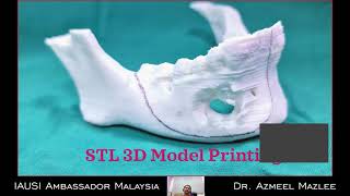 Piezotomeresection of right mandible due to unicystic ameloblastoma [upl. by Attirehs652]