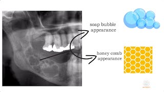 Ameloblastoma part 1 [upl. by Adrell85]