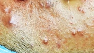 Extraction dacné kystique et pustule  cystic acne [upl. by Rocray]