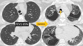 Bronchitis Animation [upl. by Arrac]