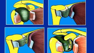 ALGODYSTROPHIE  effets secondaires  traitements naturels  Comment sy retrouver [upl. by Guidotti]