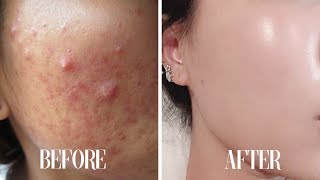 Get CLEAR SKIN subliminal  Get rid of acne in 10 minutes [upl. by Mairhpe]