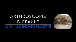 EPAULE N°2  Acromioplastie [upl. by Junno]