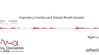 The Lung Sounds of Pneumonia [upl. by Dalia]