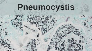 Pneumocystis Pneumonia  Pathology mini tutorial [upl. by Frye]