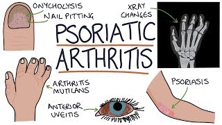 Psoriatic Arthritis [upl. by Einnad]