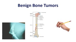 BENIGN NONCANCEROUS LIVER TUMORS by Dr Robert Gish [upl. by Smiley]