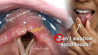 Cricopharyngeal Dysfunction Difficulty Swallowing Especially Solid Foods [upl. by Arba938]