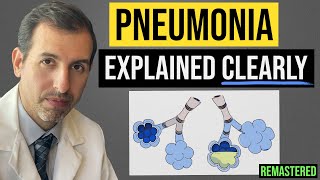 Pneumonia Explained Symptoms Diagnosis Labs Treatment [upl. by Chaille]