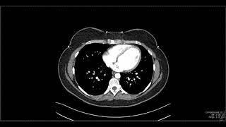 Abdominal Anatomy on Computed Tomography [upl. by Odnomar490]