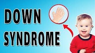 Down Syndrome Features [upl. by Suolhcin834]