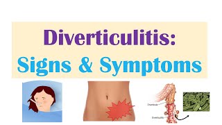 Diverticulitis Signs amp Symptoms And Why They Occur [upl. by Dorkus331]