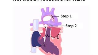 Jessicas story  Hypoplastic Left heart Syndrome HLHS [upl. by Anahpets53]