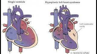 Fetal intervention in Hypoplastic Left Heart Syndrome HLHS [upl. by Enimzaj201]