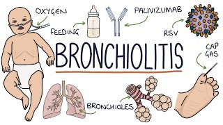 PART I  Pneumonia Overview Lobar and Bronchopneumonia [upl. by Amir]