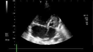 Hypoplastic Right Heart Syndrome HRHS Single Left Ventricle [upl. by Neih]